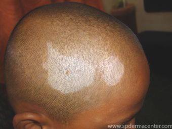 Vitiligo-Before
